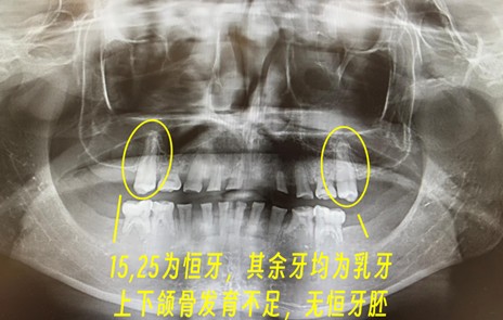 【技术解码】从“乳牙撑岗”到咬合重建：15岁少年口腔修复的全流程技术复盘